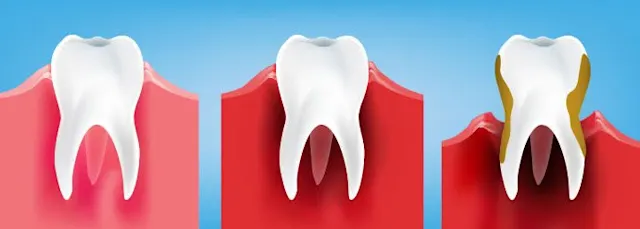 Formen der Zahnfleischentzündungen: Stadien, Faktoren und damit verbundene Krankheiten