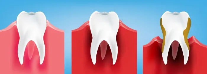 Formen der Zahnfleischentzündungen: Stadien, Faktoren und damit verbundene Krankheiten article banner
