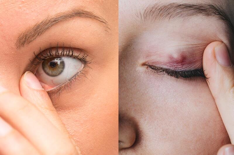 Girls-with-stye-and-chalazion-min.jpg