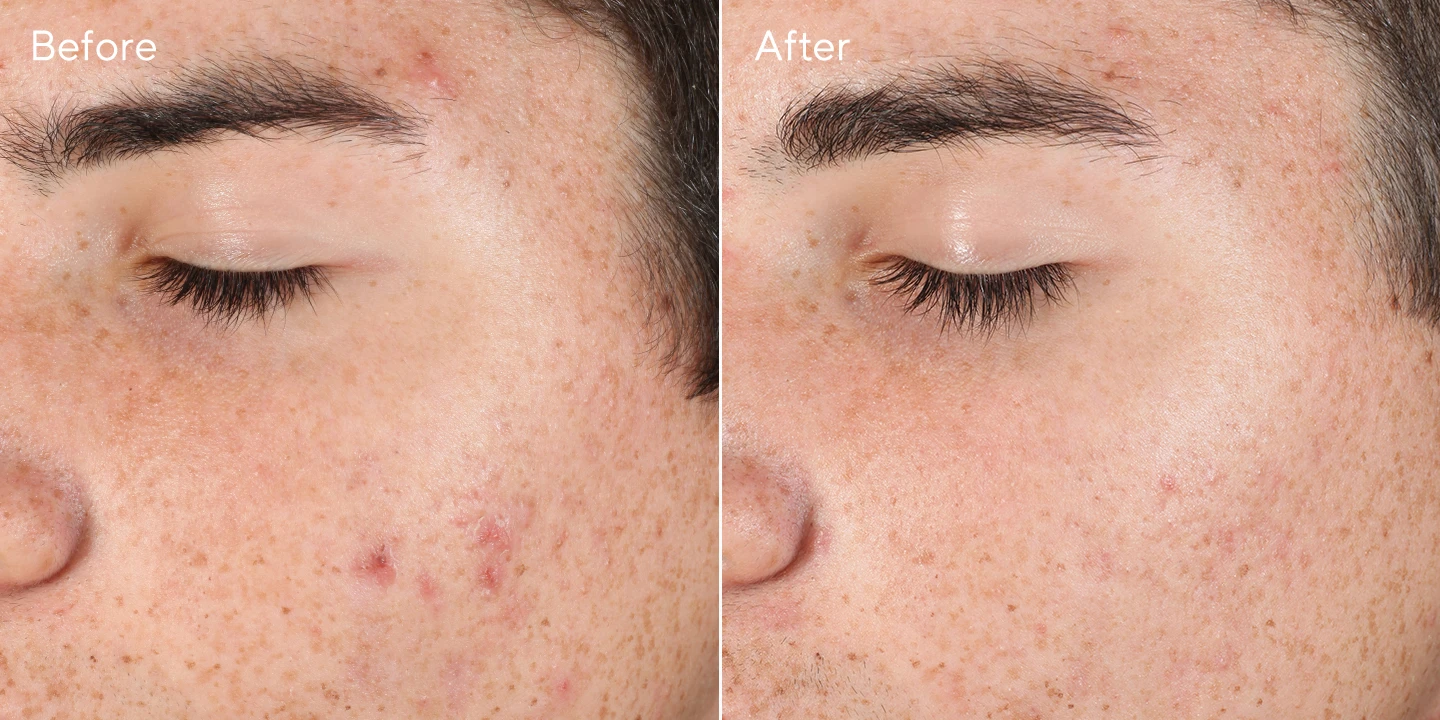 outsmart blemish before and after 3
