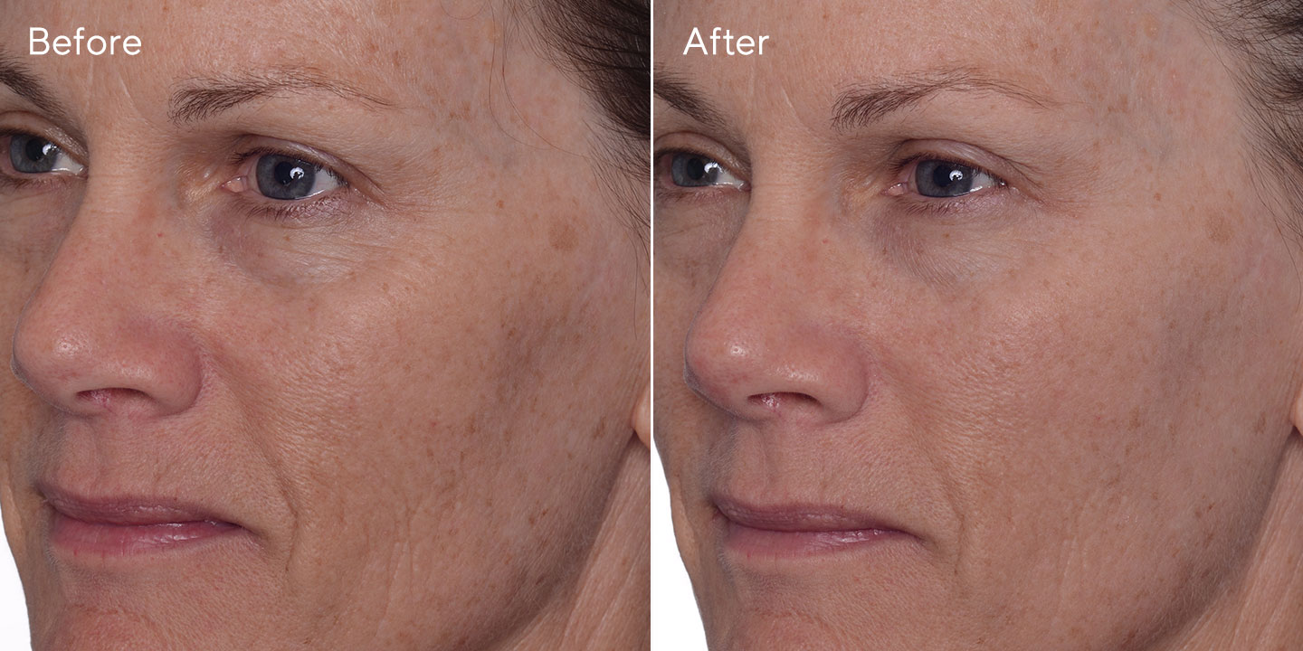 Murad Age Spot And Pigment Lightening Gel Rapid Age Spot and Pigment Lightening Serum | Murad
