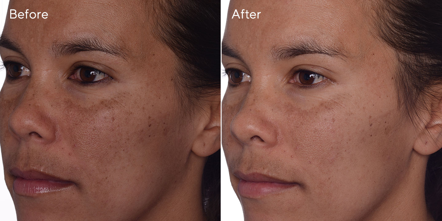 Murad Dark Spot Corrector Before And After Rapid Age Spot and Pigment Lightening Serum | Murad