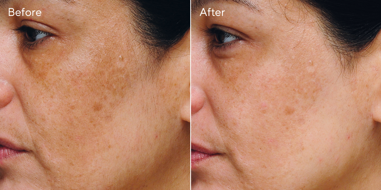 Murad Age Spot And Pigment Lightening Gel Rapid Age Spot and Pigment Lightening Serum | Murad
