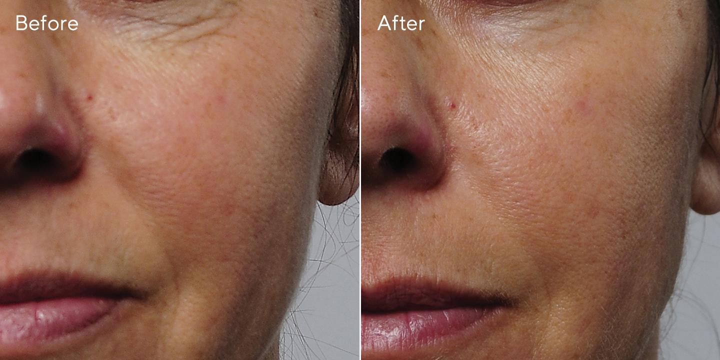 ivi collagen before and after