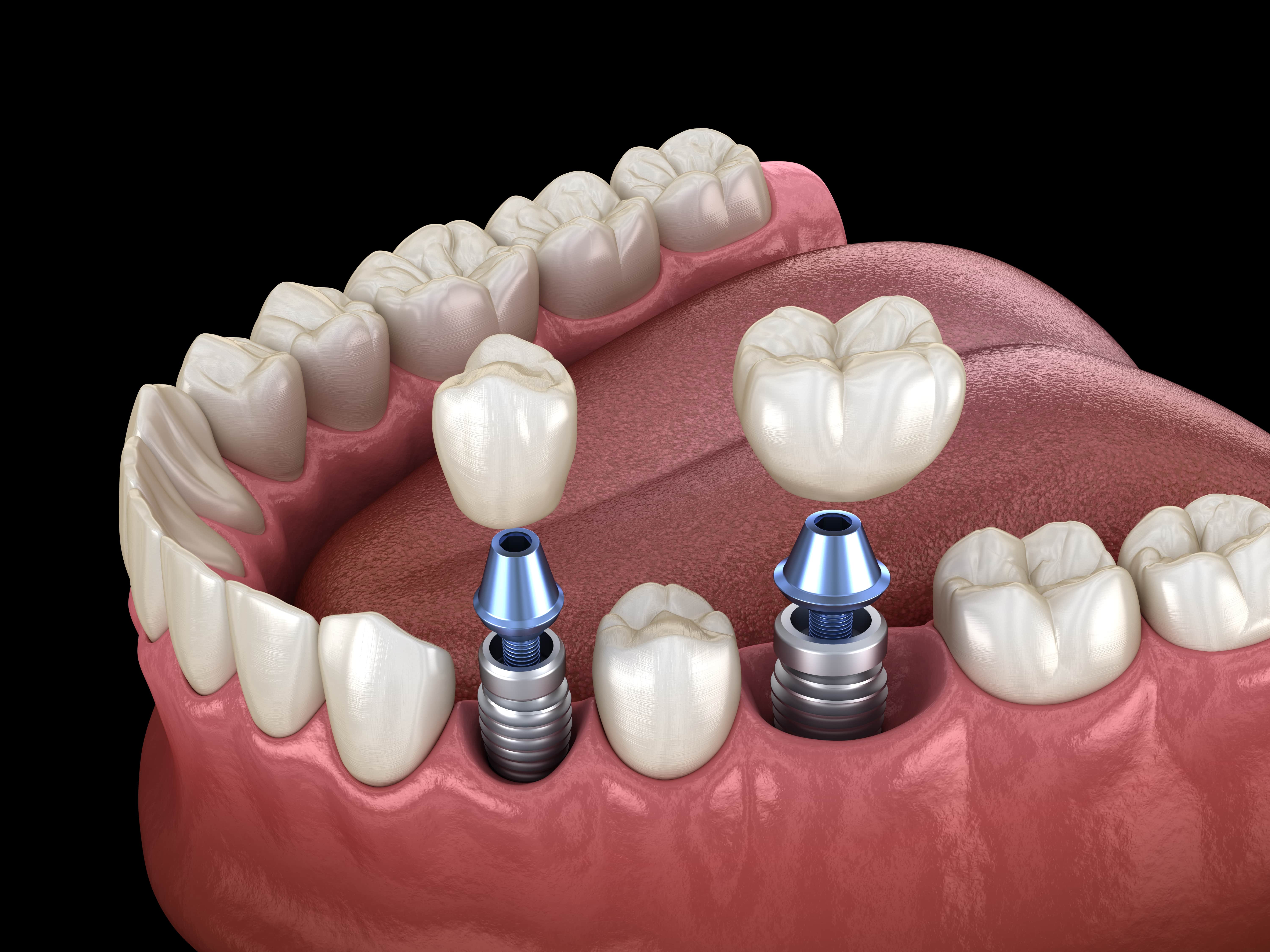 Implantology 6