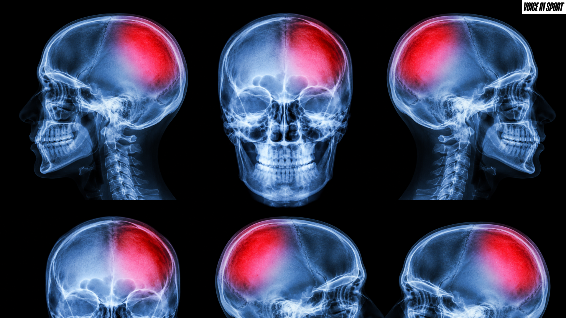 vis-post-How Concussion Recovery Impacts Mental Health