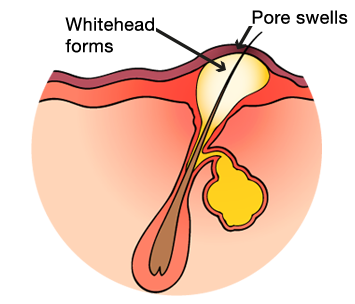 white head formation 