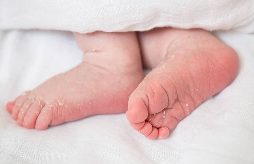 Baby & Newborn Skin Peeling - Causes and Remedies