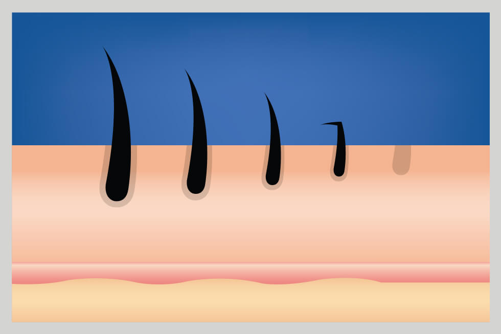 Scalp with an average amount of hair showing the causes of hair loss.