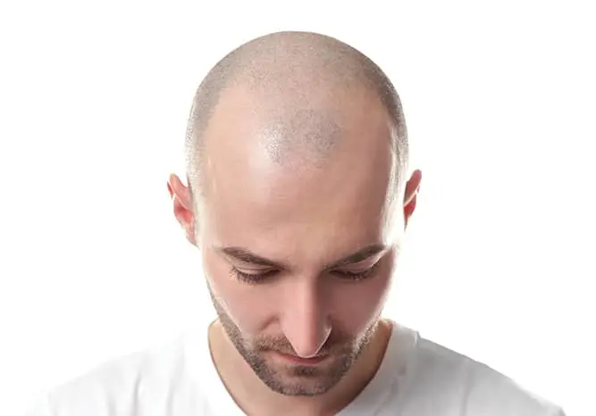 a man with male pattern baldness
