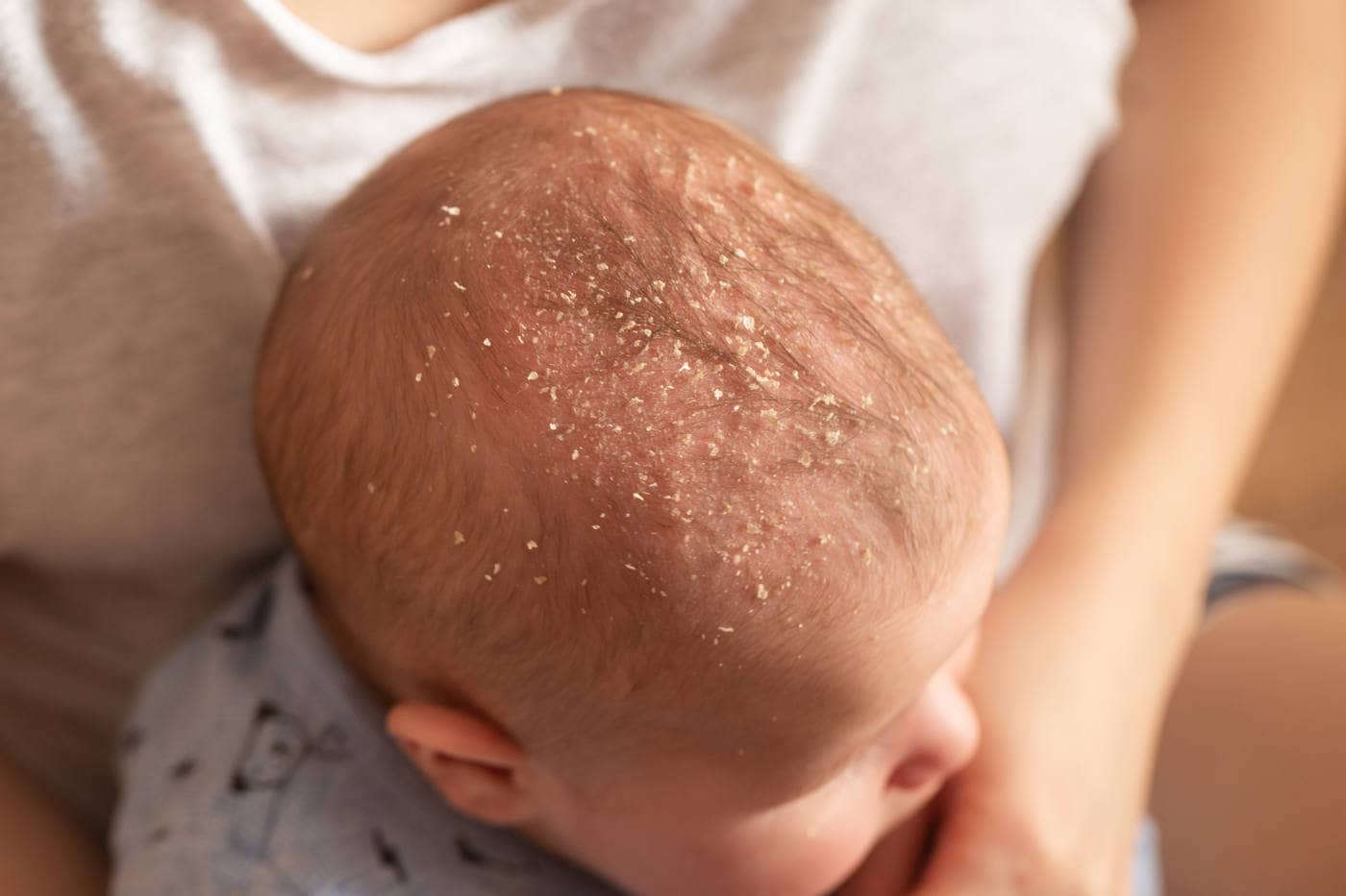 Cradle cap treatment online