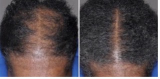 Before and after image of hair regrowth during clinical trials after using REGAINE®