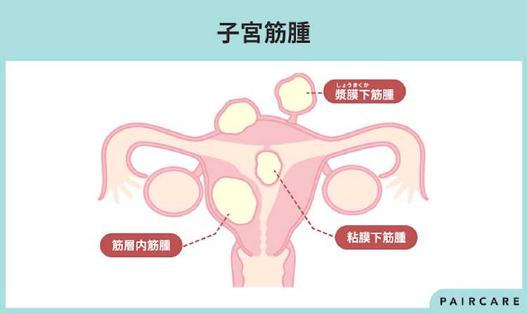 「子宮筋腫」とは