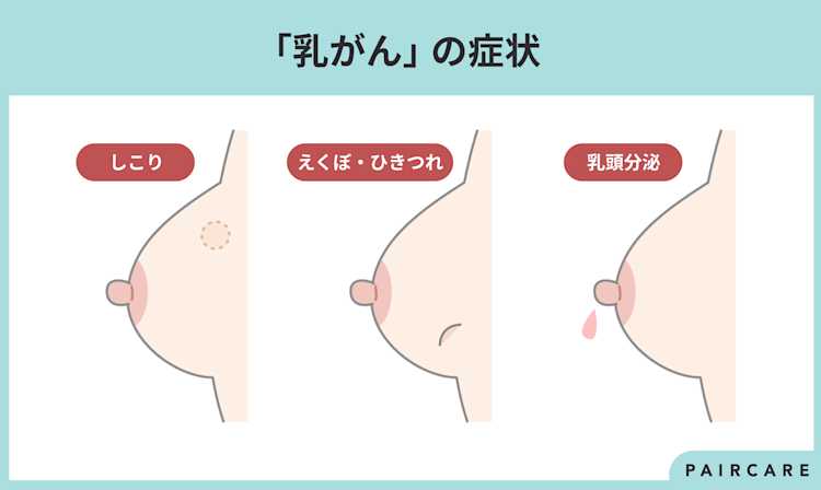主な乳がんの症状の図解
