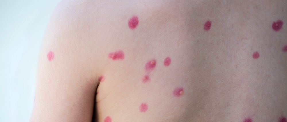 Should your child get the chickenpox vaccine?