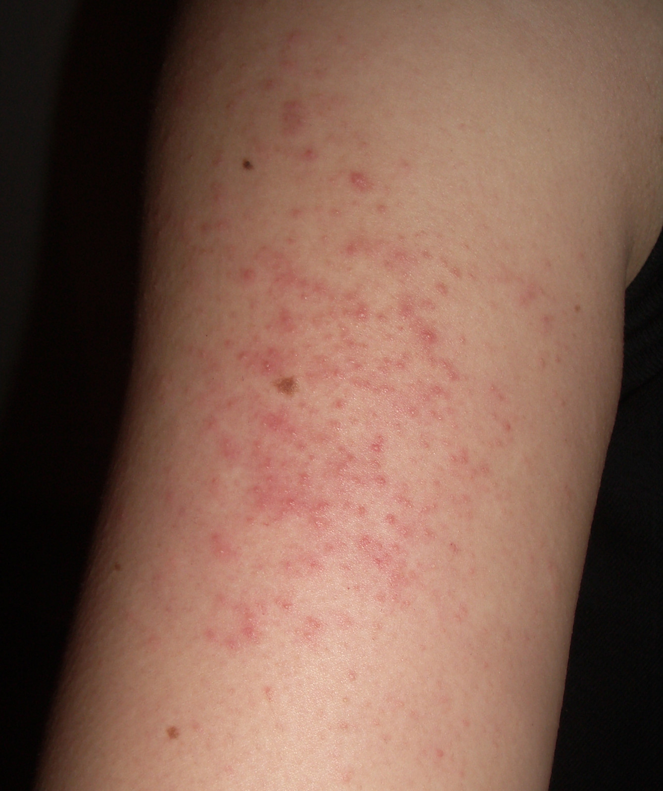 Upper arm showing keratosis pilaris.