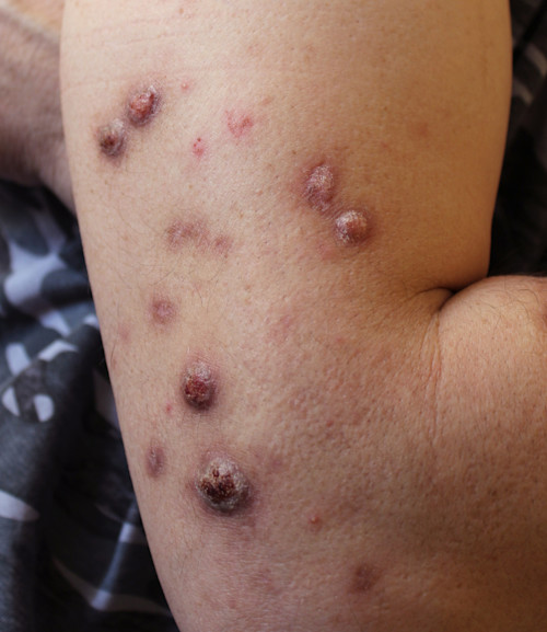 A case of prurigo nodularis in a male