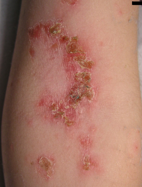 Impetigo elbow