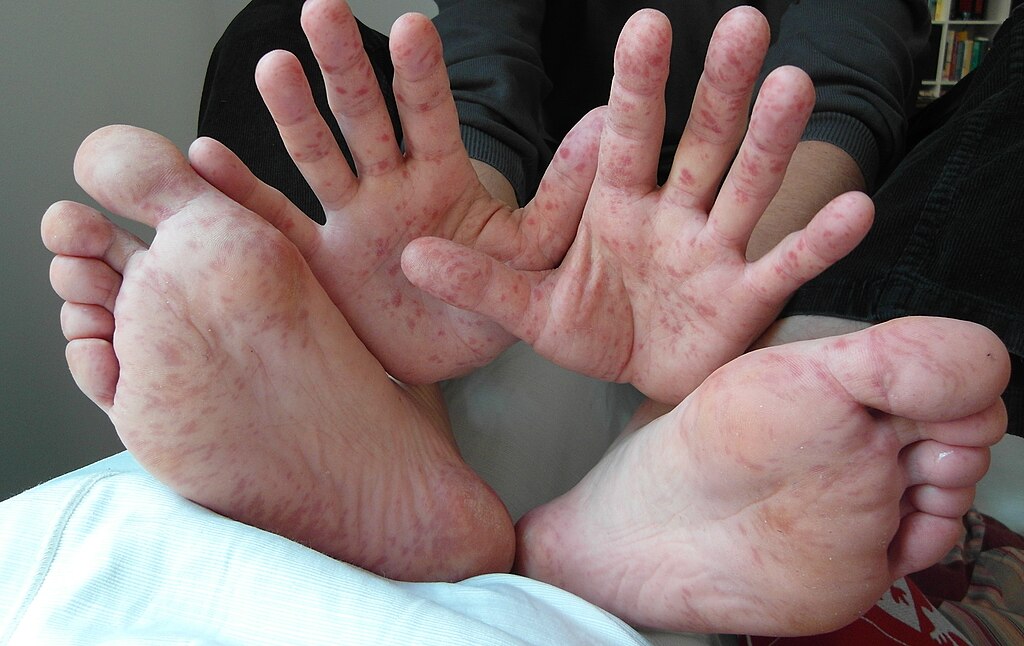 Photo of Hand, foot and mouth disease