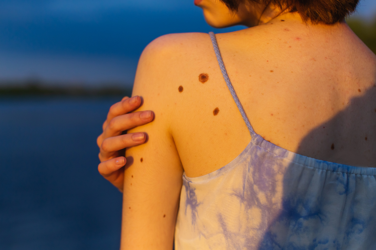 Whole body 3D mole mapping: the future of skin health?