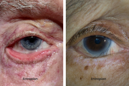 A side by side image of an eye with ectropion and another eye with entropion