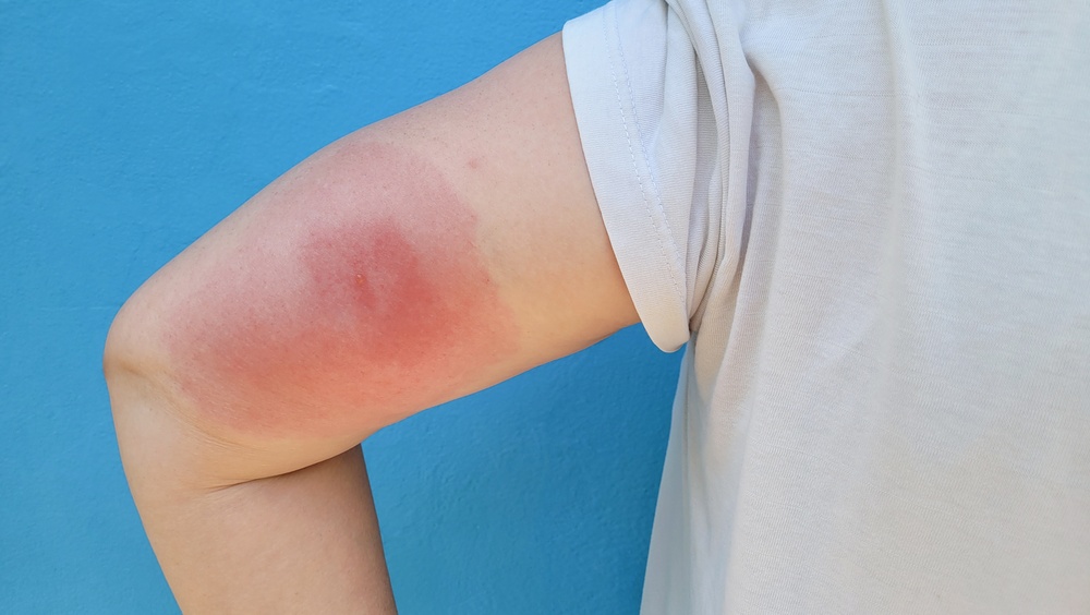 A close-up of a person's elbow showing a red, inflamed mosquito bite (skeeter syndrome) against a blue background.