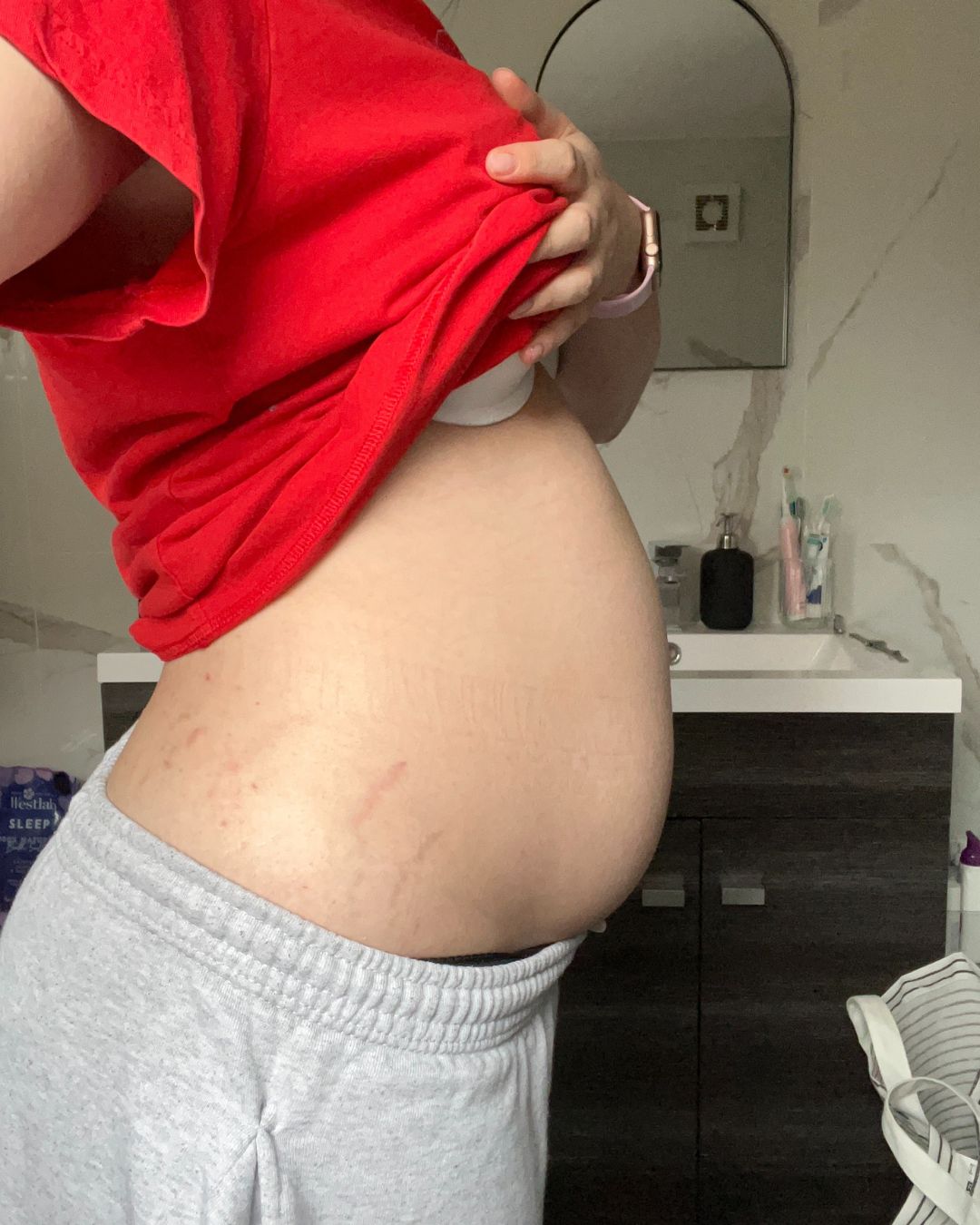 Photograph of a young woman holding up her t-shirt to show an abnormally bloated stomach.