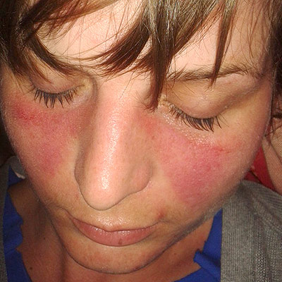 Photo of face with lupus 