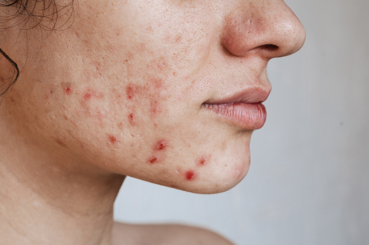 Acne: Causes, Symptoms, and Treatment