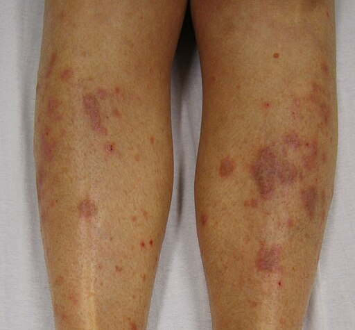 lichen planus