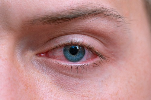 A close of up an irritated red eye