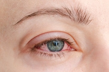 A close up of swollen red eye caused by allergies
