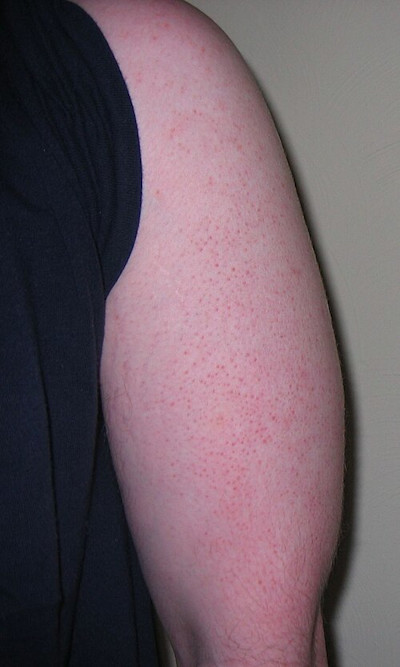 Keratosis pilaris on arm
