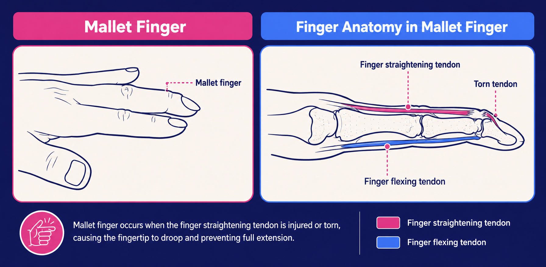 Diagram of the hand showing mallet finger