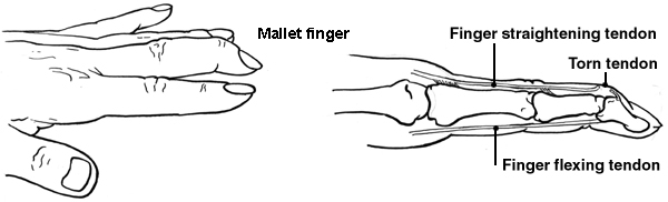 Diagram of the hand showing mallet finger