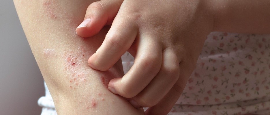 Eczema itch