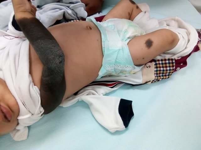 Congenital melanocytic naveus