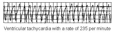VENTRICULAR TACHYCARDIA