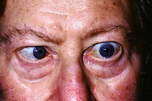 VI AND XII NERVE PALSIES