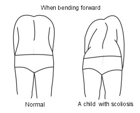 scoliosis diagnosis