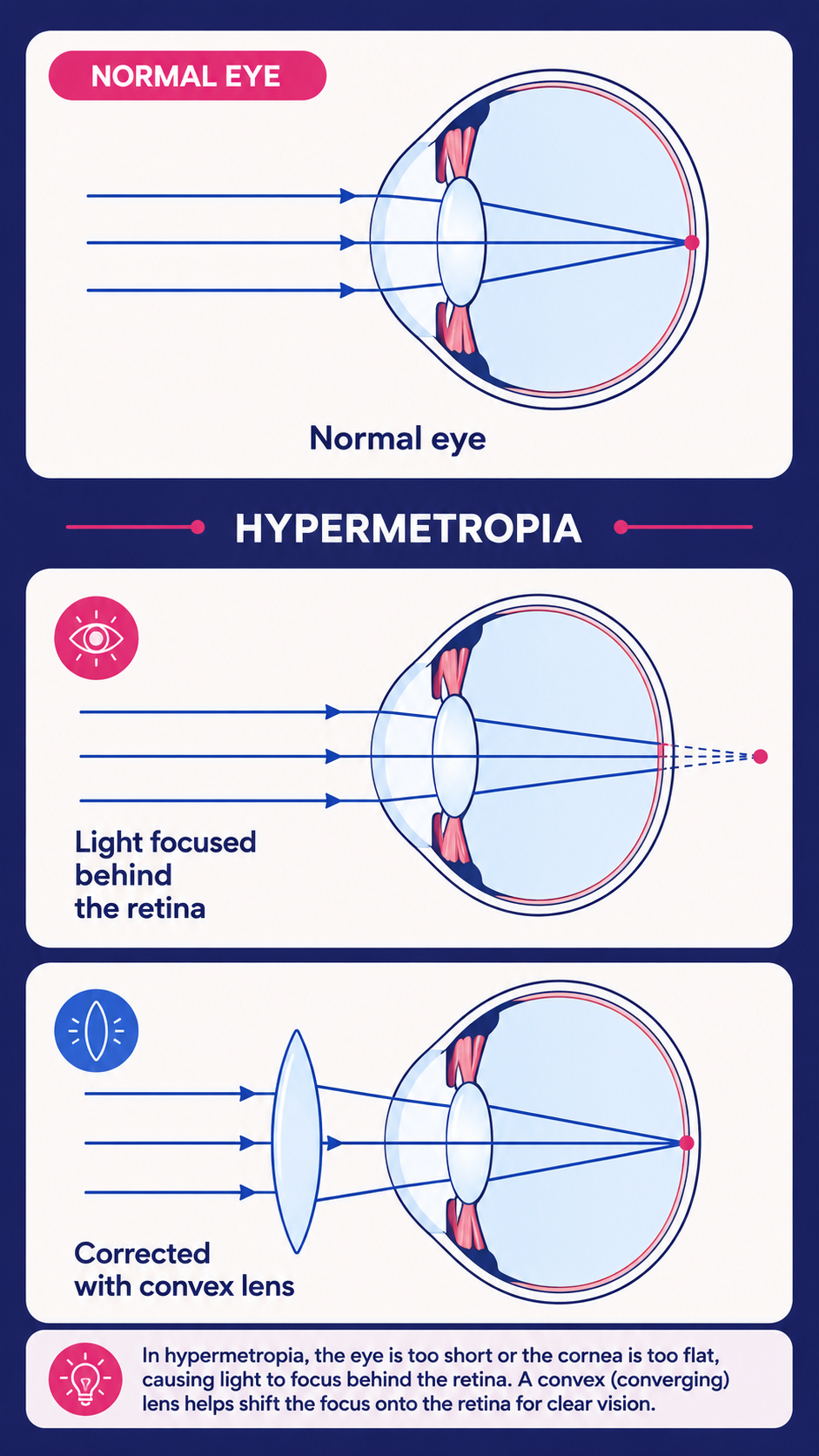 Hypermetropia long-sightedness