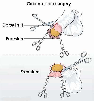 Circumcision, MrArifnajafov [CC-SA-1.0] via http://en.wikipedia.org/wiki/File:Circumcision_illustration.jpg
