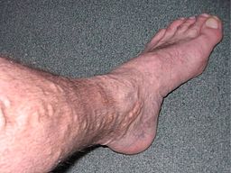 Varicose veins on leg