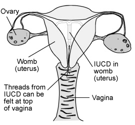 IUD in place
