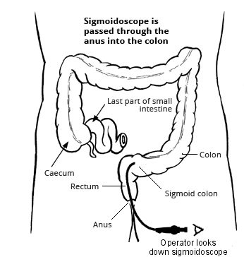 Sigmoidoscopy