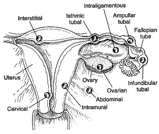 Ectopic pregnancy locations