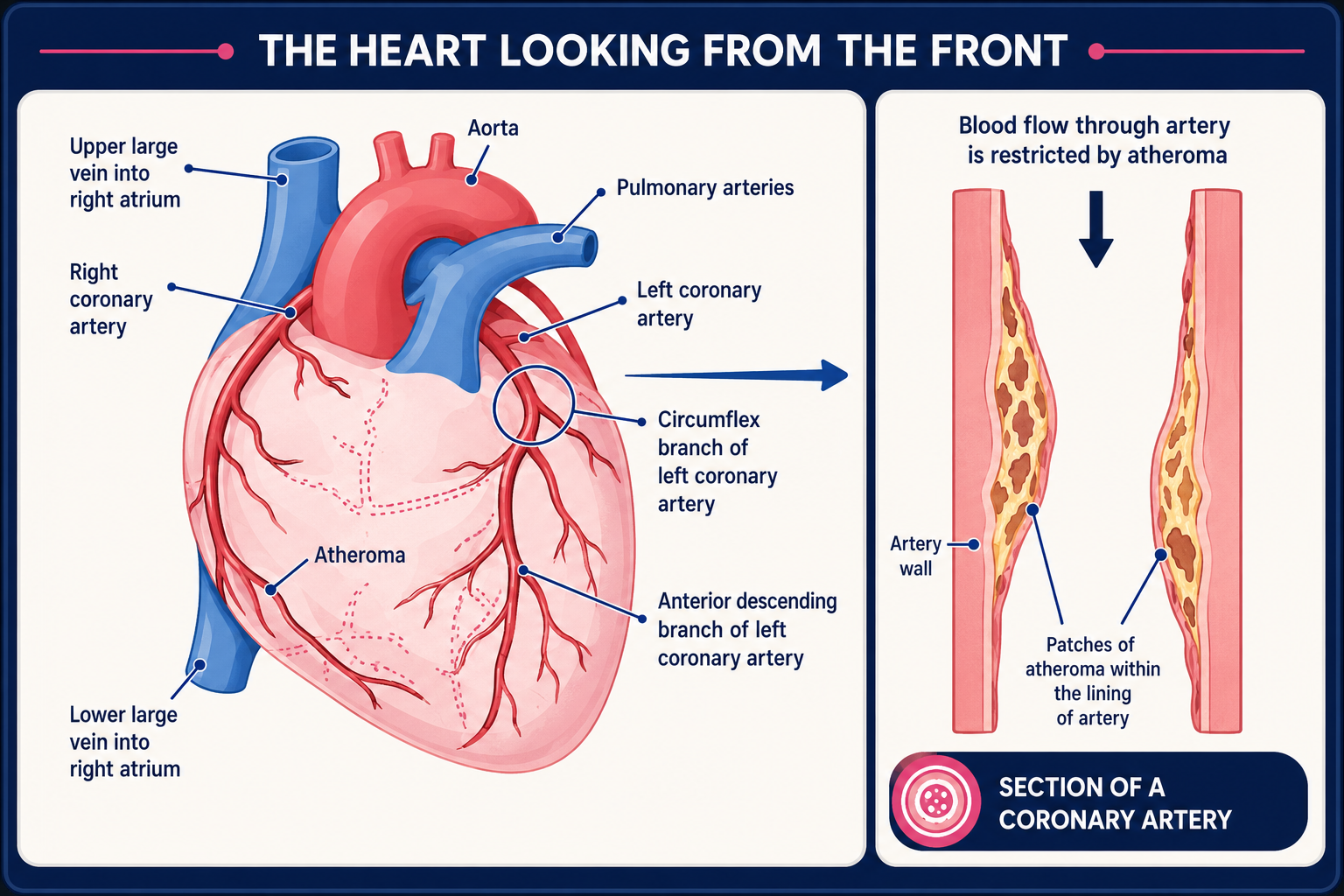 Heart with atheroma