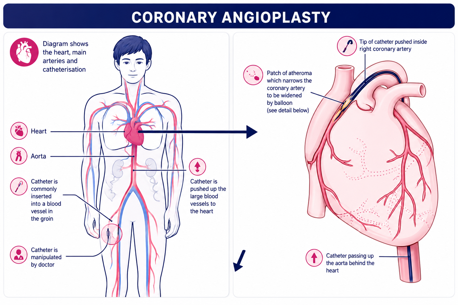Angioplastie coronarienne