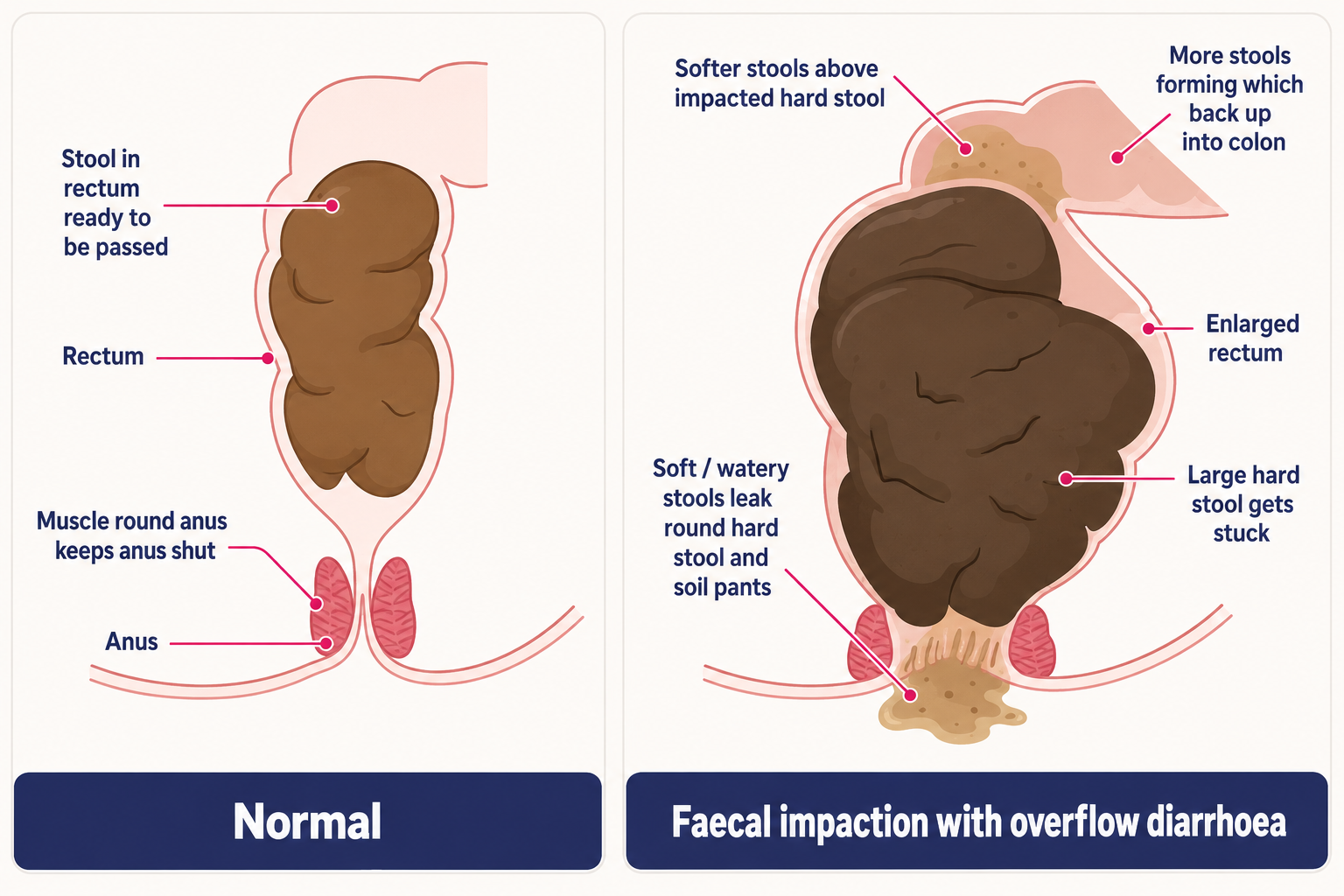 Chronic constipation