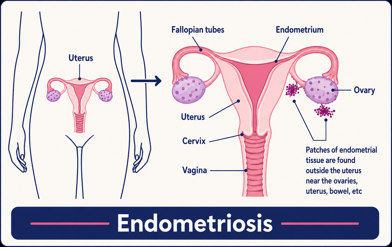 Endometriosis